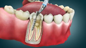 Signs You Need a Root Canal in Edmonton